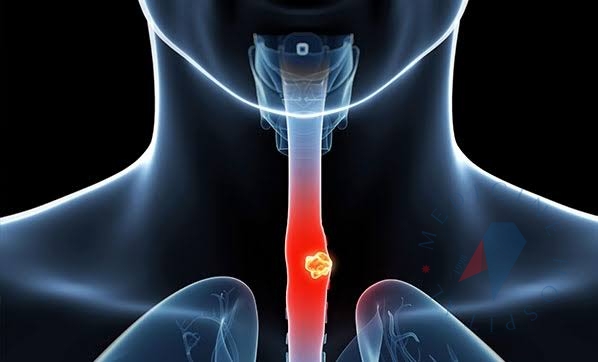 Yutma Bozukluğu (Disfaji) Nedir?