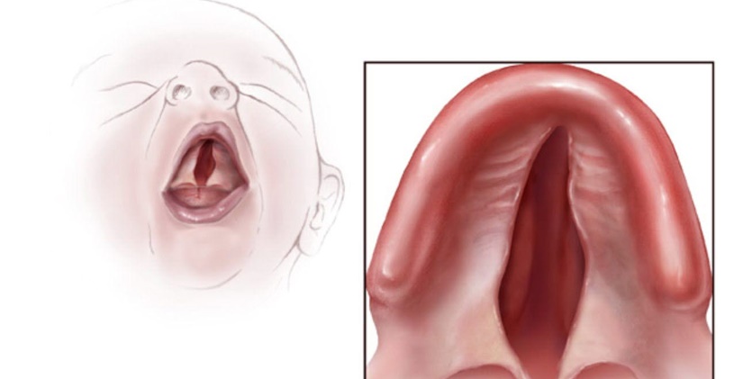 Yarık Damak Tedavi Sürecinde Dil ve Konuşma Terapistinin Rolü