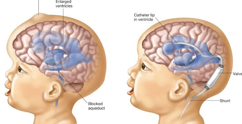 Hidrosefali Nedir ve Tedavisi Nasıldır?