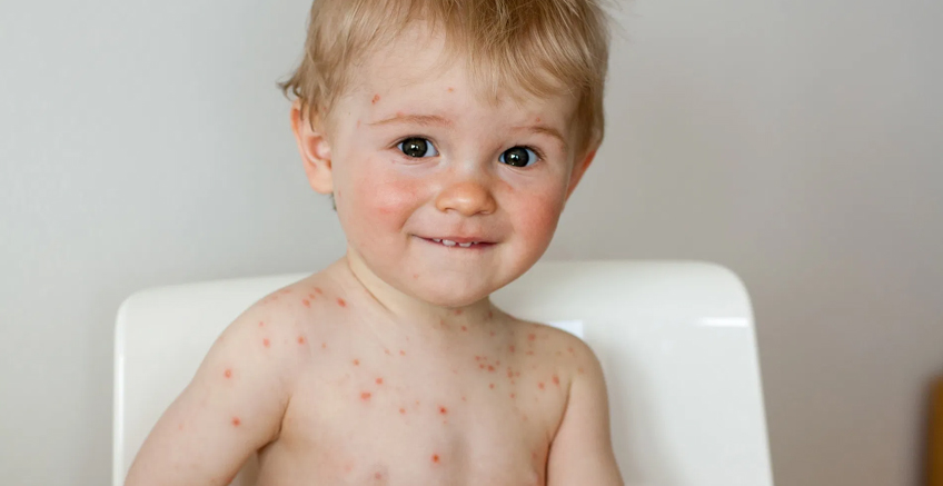 Çocuklarda Suçiçeği