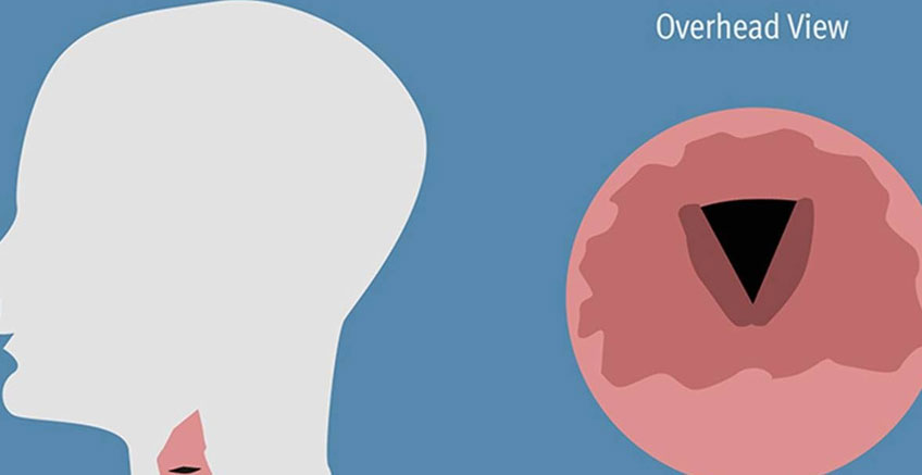 Paradoksal Vokal Kord Hareketi