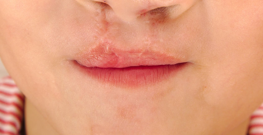 Yarık Dudak ve/veya Damakla Doğmuş Bebeklerin Bakımı: AAP Raporu