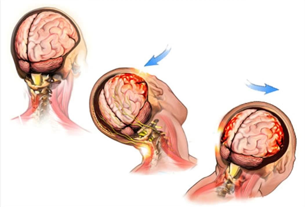 Travmatik Beyin Hasarı