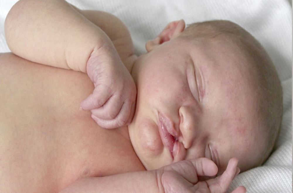 Dudak-Damak Yarıklığına Bağlı Konuşma Bozukluğu