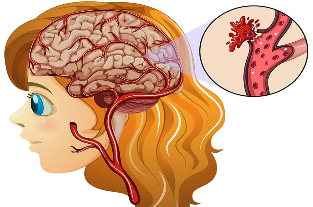 Psödoanevrizma Her Zaman Tedavi Edilmeli Mi?