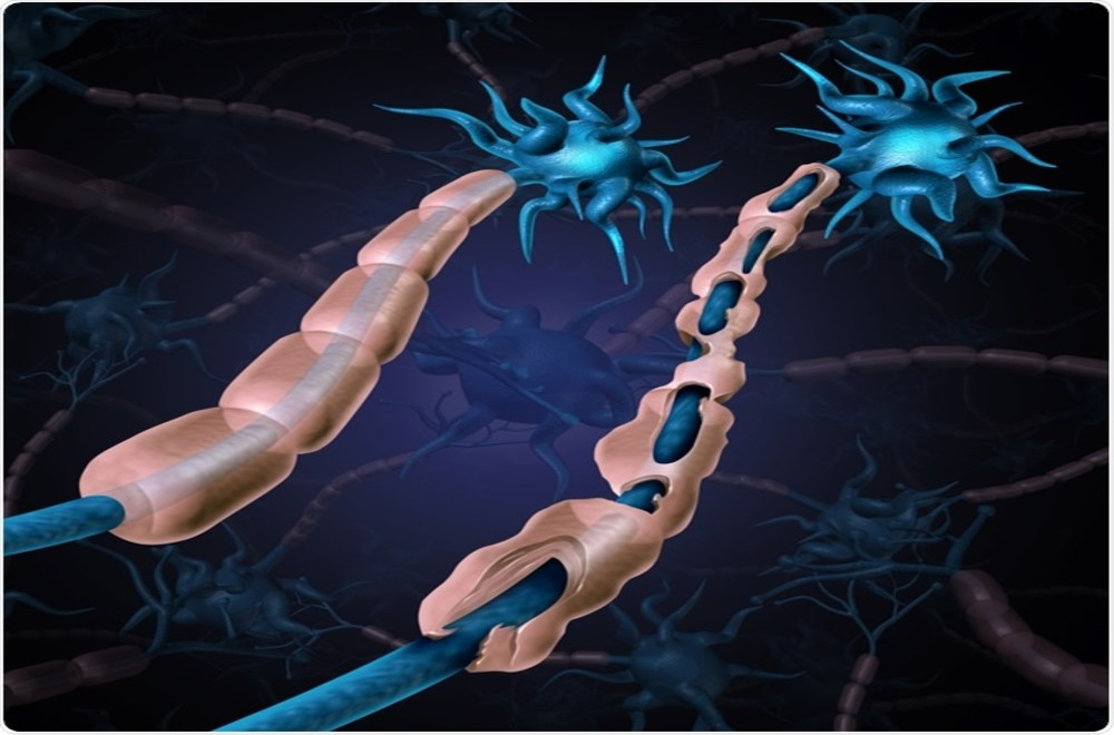 Guillain-Barré Sendromu Nedir?